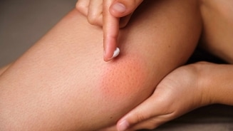 Persoon brengt zalf aan op een rode geïrriteerde huid op het been