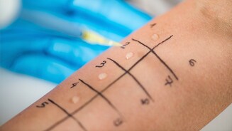 Allergietest op arm met getekende markeringen en vloeistofdruppels.