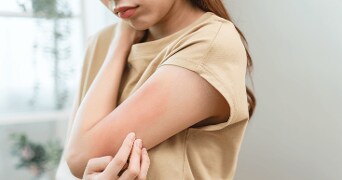 Vrouw met rode plek op arm, mogelijk als gevolg van een allergische reactie of huidirritatie.