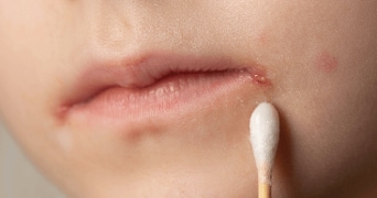 Close-up van lippen en huid met wattenstaafje bij wondje